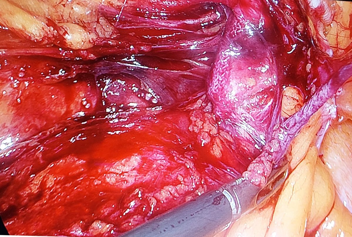 Abordaje laparoscópico de una hernia inguinal recidivada después una hernioplastia de Rutkow-Robbins.
<a href="/alvarodoc86/">Álvaro Hernández Pérez</a> <a href="/DrNicolasMacias/">Nicolás Macías Hernández</a> #SoMe4Surgery