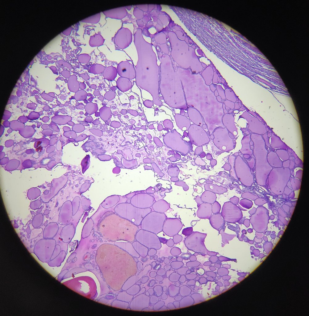 Shruti79688953's tweet photo. 62 year female hemithyroidectomy #multinodulargoitre with degenerative changes https://t.co/6sjhxNX70j