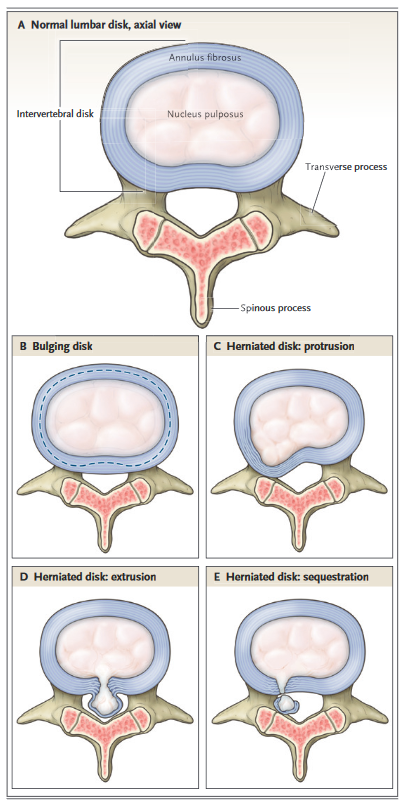 PhysioMeScience's tweet photo. CT and MRI Terminology for Herniated Disks.

👇👇👇

https://t.co/RWk75v5Zwp

👉 Panel A shows a normal lumbar intervertebral disk.

👉 Panel B shows a bulging disk. The dashed line indicates the normal disk space. Annular tissue extends beyond the normal disk space. https://t.co/H4sfPQWgqJ