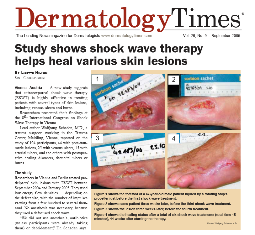 MTSSparkWave's tweet photo. Milestones in Shock Wave Therapy!
Check out the first steps made with dermagold on chronic wounds in 2005. Dr. Wolfgang Schaden demonstrated the healing effect with the unfocussed SoftWave applicator OP155.
Find more publications at https://t.co/KashIxUZbW
#MTSMedical #ESWT https://t.co/ISwIdiMiYs