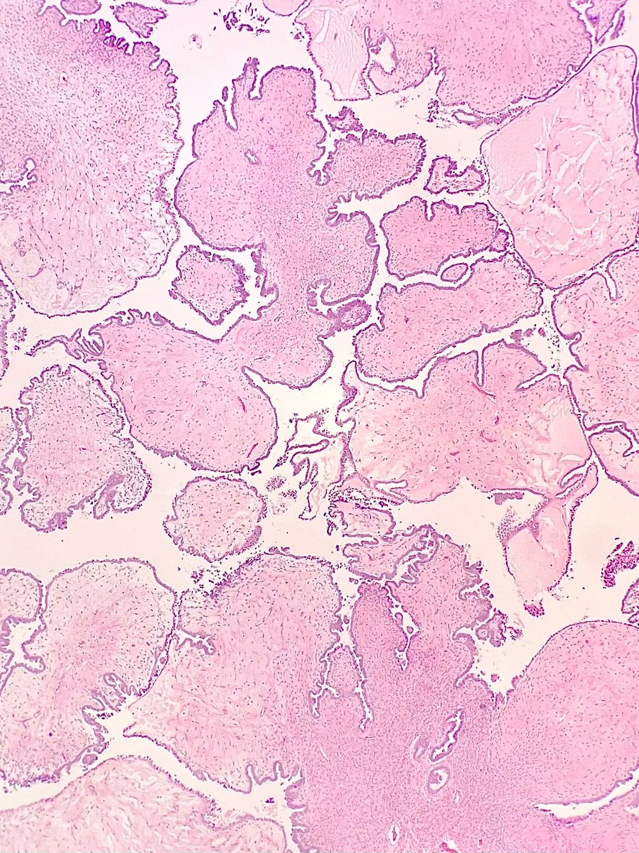Gloria_SuraMD's tweet photo. Oophorectomy specimen revealing what type of tumor? Answer: https://t.co/YozPq0UuhO    #PathArt #PathTwitter #MedTwitter https://t.co/DZaa6y4Fik