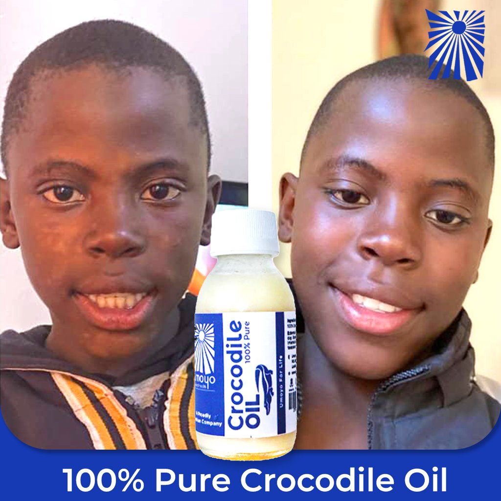 UmoyoNH's tweet photo. Milton Chisenga. Had skin rash that looked like ringworms, one day in 2022 his mother Esther gave him some crocodile oil. These are the results he got after using it

Thank You Umoyo.

https://t.co/ijY3gjIXfM

Impacting Lives Naturally

#LoveYourUmoyo #health #healthylife #lusaka https://t.co/suuWHkQ54U