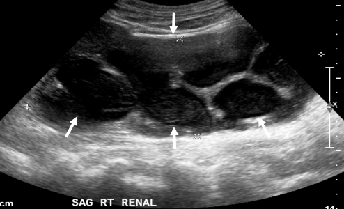 BIR Journals (@bjr_radiology) on Twitter photo #OpenAccess Review
Imaging of renal emergencies: Review of infectious, hemorrhagic, vascular, and traumatic etiologies
bit.ly/3nWdYUV
#Radiology <a href="/ErickMRemer/">Erick Remer</a> @FeldmanMrya <a href="/DavidESweet1/">David Sweet</a> #OpenAccess Review
Imaging of renal emergencies: Review of infectious, hemorrhagic, vascular, and traumatic etiologies
bit.ly/3nWdYUV
#Radiology <a href="/ErickMRemer/">Erick Remer</a> @FeldmanMrya <a href="/DavidESweet1/">David Sweet</a>