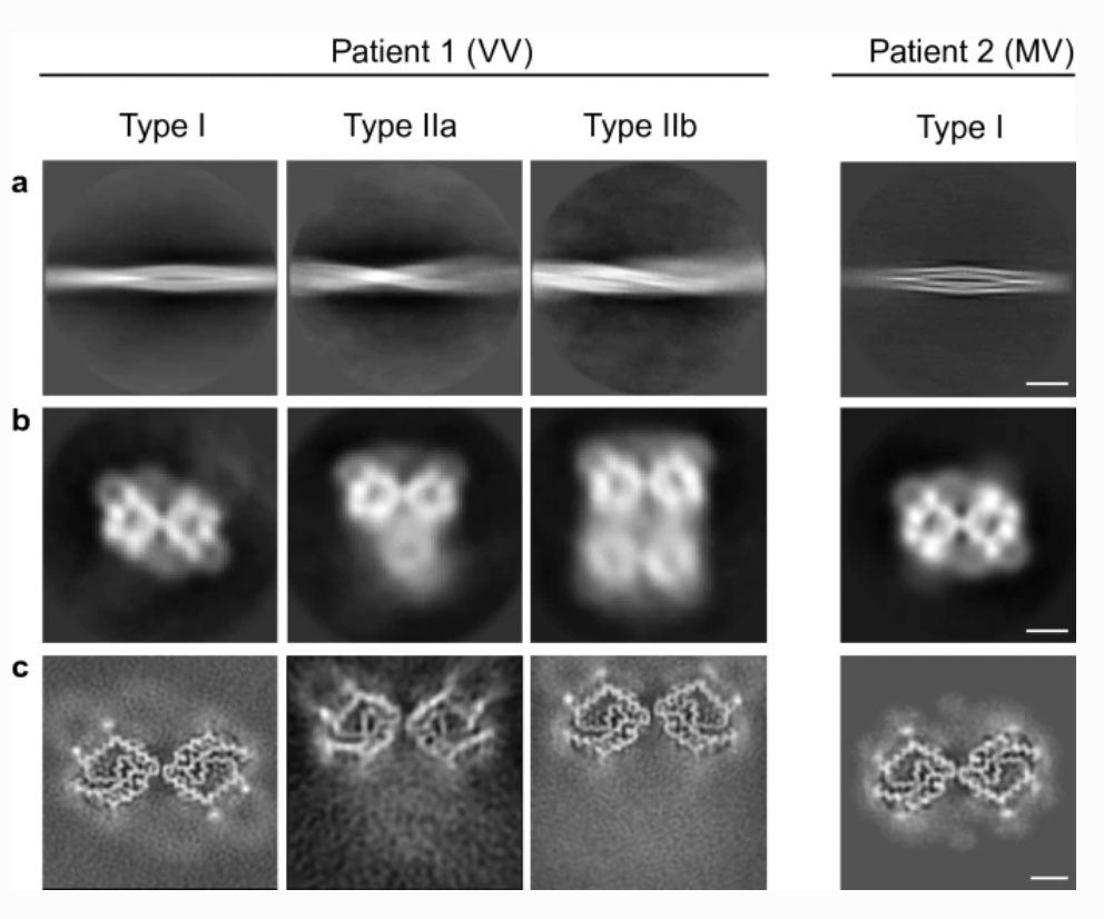 GraceHallinan's tweet photo. Our paper was published today in Acta Neuropathologica! We solved the atomic structure of PrP by cryoEM; the first human brain-derived prion structure, and it's beautiful. Grateful to everyone involved in this work, including the patients &amp; their families. https://t.co/pexYfvWD6G https://t.co/y5M59xJEvF