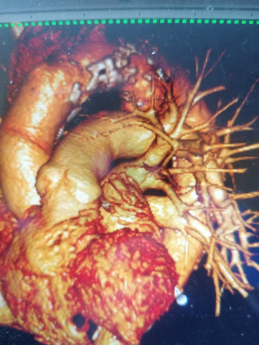 FabioPastore81's tweet photo. 67 old male patient, asymptomatic, abdominal aortic aneurism (53mm). How should I treat saccular descending aorta aneurism( 46mm,depth 17 mm, width 26 mm  ? Best medical therapy? Endovascular treatment? Open surgery? https://t.co/W9Z28Houce
