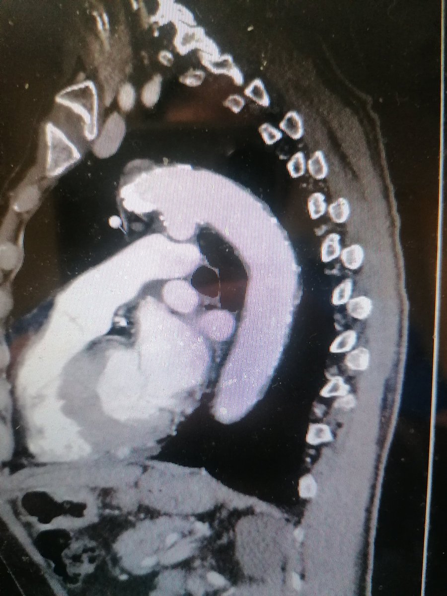 FabioPastore81's tweet photo. 67 old male patient, asymptomatic, abdominal aortic aneurism (53mm). How should I treat saccular descending aorta aneurism( 46mm,depth 17 mm, width 26 mm  ? Best medical therapy? Endovascular treatment? Open surgery? https://t.co/W9Z28Houce