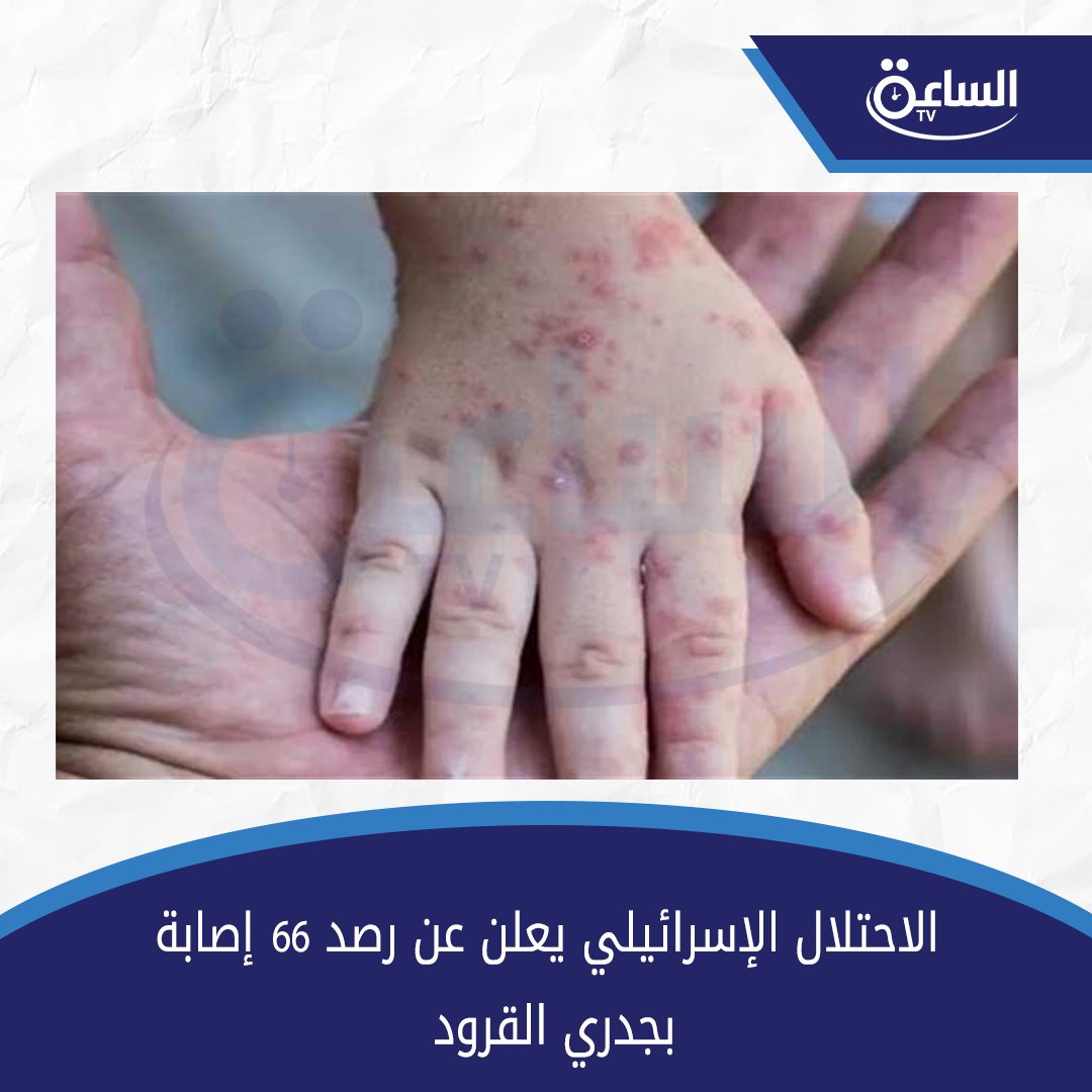 الاحتلال الإسرائيلي يعلن عن رصد 66 إصابة بجدري القرود