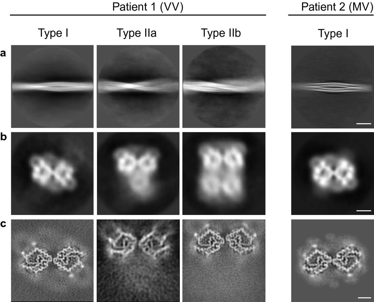 Proud to share the first major work from my PhD with <a href="/JiangLabCryoEM/">Jiang Lab@PennState</a>. We used cryoEM to determine the atomic structures of the first human brain-derived prion protein filaments from Gerstmann–Sträussler–Scheinker disease. link.springer.com/article/10.100…