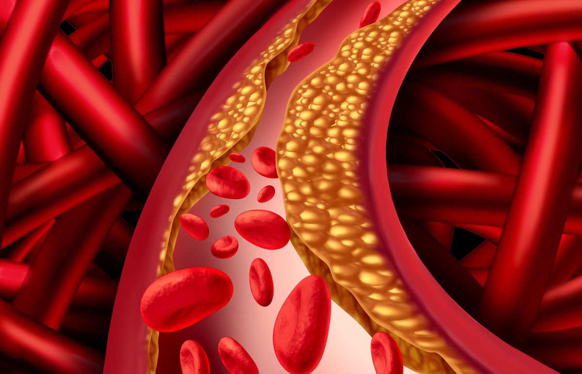 CardiologyNJ's tweet photo. FAQ: What is coronary artery disease? CAD is the most common type of heart disease, and occurs when the arteries that supply blood to the heart become hardened and narrowed due to a buildup of plaque on their inner walls. #cardiology #hearthealth #heartdisease #healthyliving https://t.co/hgN9zSWZbs