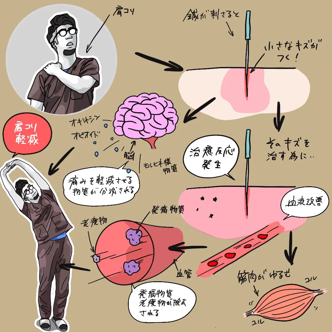 鍼治療が効く理由をざっくり図解！とても分かりやすい！！