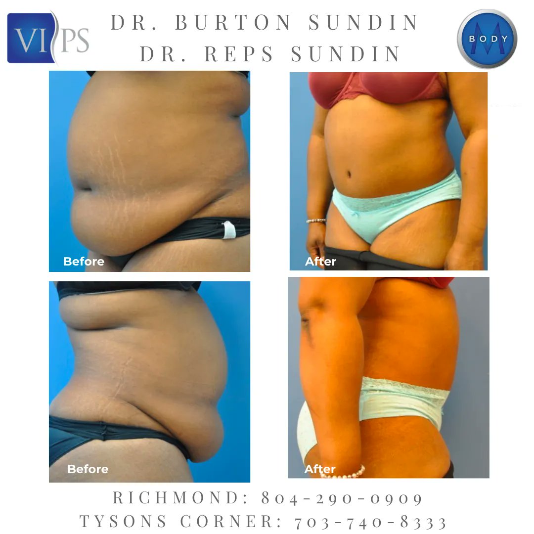 mbodycenter's tweet photo. This patient came in for a Tummy Tuck and she looks fabulous with here results! 
Call today Tyson’s Corner (703) 740-8333 Richmond (804) 290-0909
#PlasticSurgery #PlasticSurgeons #Richmond #NorthernVirginia #VIPS #DrsSundin #TysonsCorner #ViennaVA #WashingtonDC #vienna #fairfax https://t.co/CjFLizeb02