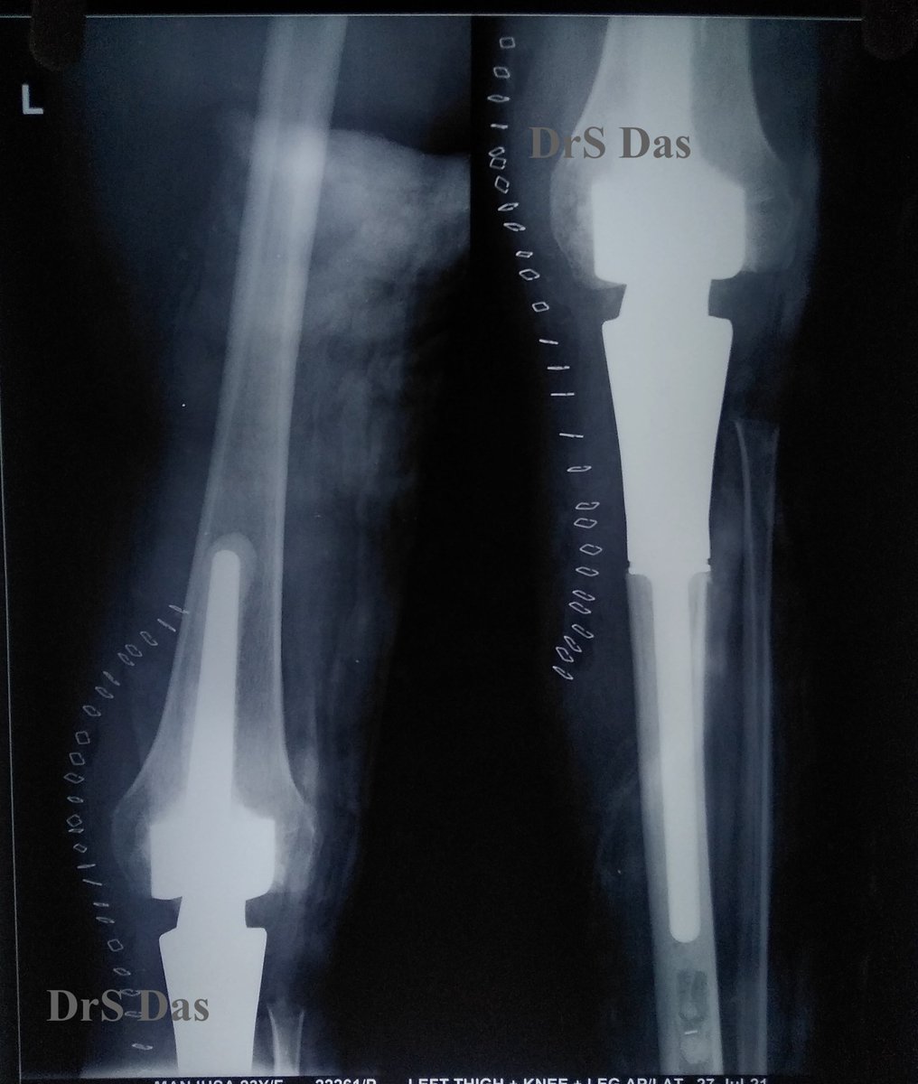 sdorthopod's tweet photo. One year back during the 2nd wave of COVID,achieved the feat of performing the FIRST-Ever Megaprosthetic Knee Reconstruction in Our Institute.Had the pleasure of being featured in Media.#successful #megaprosthesis #kneereplacementsurgery #bonetumour #satisfiedpatient #sdorthopod https://t.co/4vPYUs4eYm