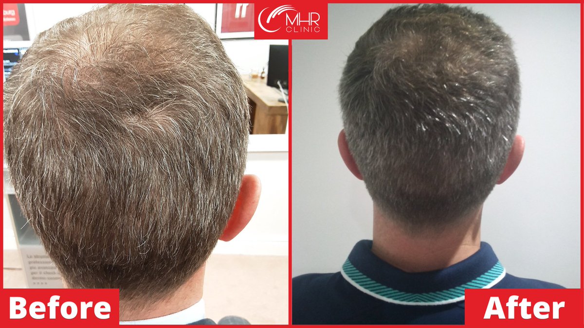 MHRClinicUK's tweet photo. Andy approached MHR wanting to restore his thinning hair whilst preventing any further hair loss.

After 8 months of LLLT (Low-level laser therapy) including specialised prescribed medication and bespoke herbal supplementation.  

Andy has had an incredible transformation. https://t.co/GFVOMs3ZRE