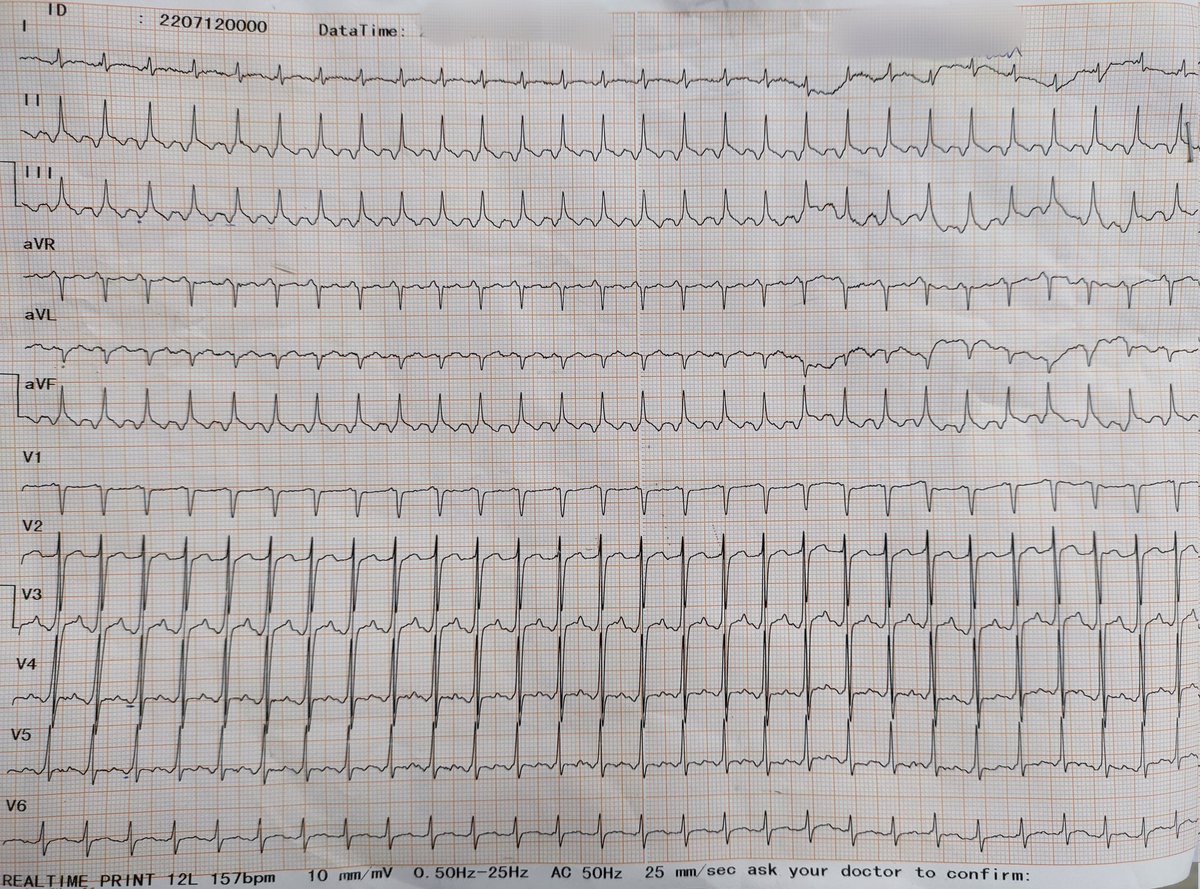 Dr_Unique's tweet image. Diagnosis?
#ECGfirst