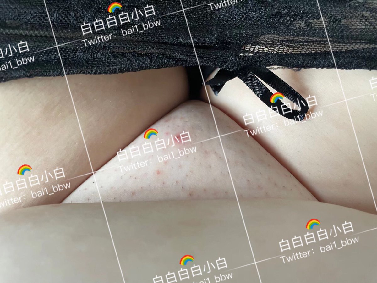 bai2_bbw's tweet photo. 第二十三次
应该是前天？打的
毛囊炎又来啦
想吃一口ma https://t.co/66FLboph8I