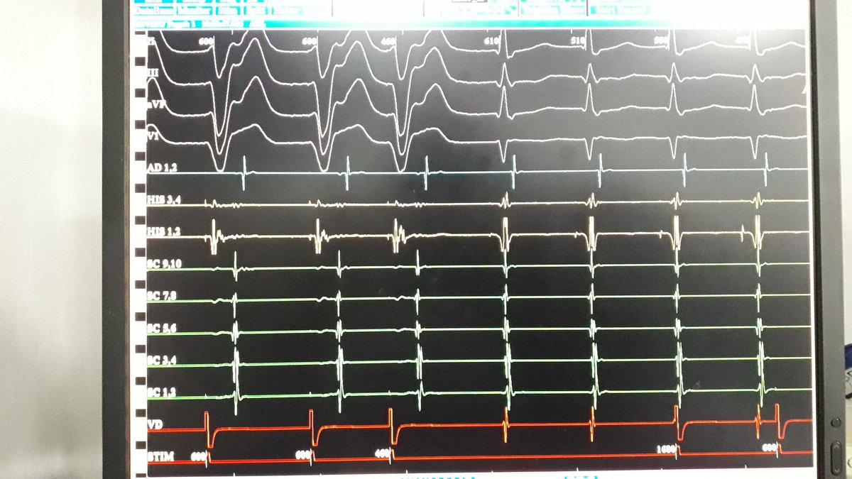 GusCostaEP's tweet photo. AVNRT induced only by RV extraestimuli. Thoughts?Case done with Dr Camila Olivera and Dr Gustavo Gomez at Hospital Posadas https://t.co/TkaE8nu5V5