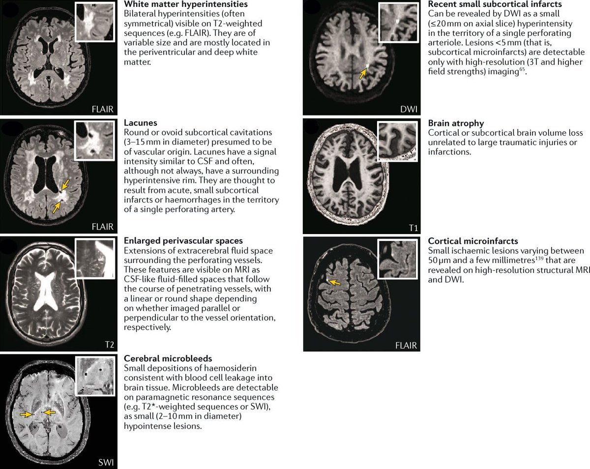 microbleeds's tweet photo. MRI features of Cerebral Small Vessel Disease

#FOAMrad #radres #NeuroRad #Neurology #Neurosurgery #RadEd #neurotwitter #NeuroTwitter https://t.co/wz652xfqq5
