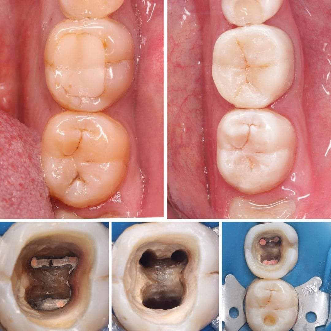 thedrshahnawaz's tweet image. Endo-resto... #endoresto #dentalphotography #directcomposite #compositefilling #cosmeticdentistry #rootcanal #rootcanaltreatment