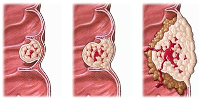 dreliasmoran's tweet photo. [CÁNCER DE COLON O COLORRECTAL (CCR)]: Qué es, cómo se desarrolla y cómo prevenirlo. Abro 🧵 https://t.co/V98HYttaeV