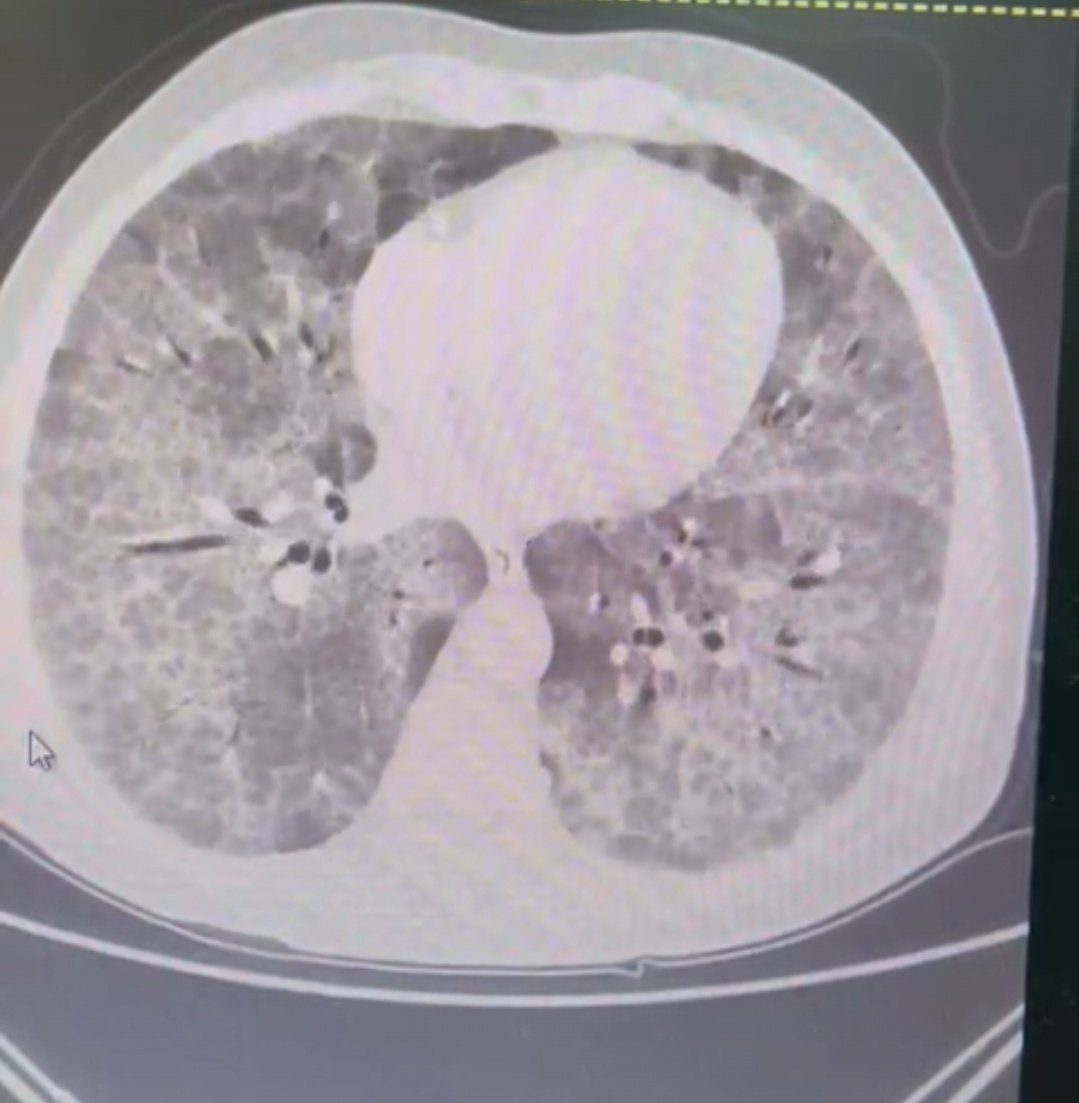 chest_doctor's tweet photo. حالة نادرة:
مدخن عمره ٥٢ سنه، لايعاني من أي أمراض مزمنة، أصيب بكوفيد وهو غير مطعم، وعانى من إلتهاب رئوي شديد، وظل في المستشفى لمدة شهرين، على الأكسجين، يعاني من أجل أخذ النفس
وأظهرت أشعته: 👇 https://t.co/zeMjaRShu6