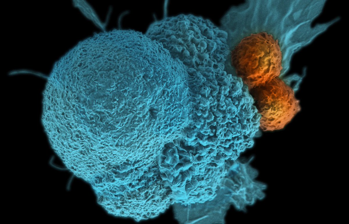 AzizianRahim's tweet photo. Drugs that unleash the power of the immune system against tumours can elicit cancer-fighting T-cell responses when given to people before initial surgery, according to a study in people with oral #cancer 1.
https://t.co/nwDI0pv8UM https://t.co/6eGwRdD330