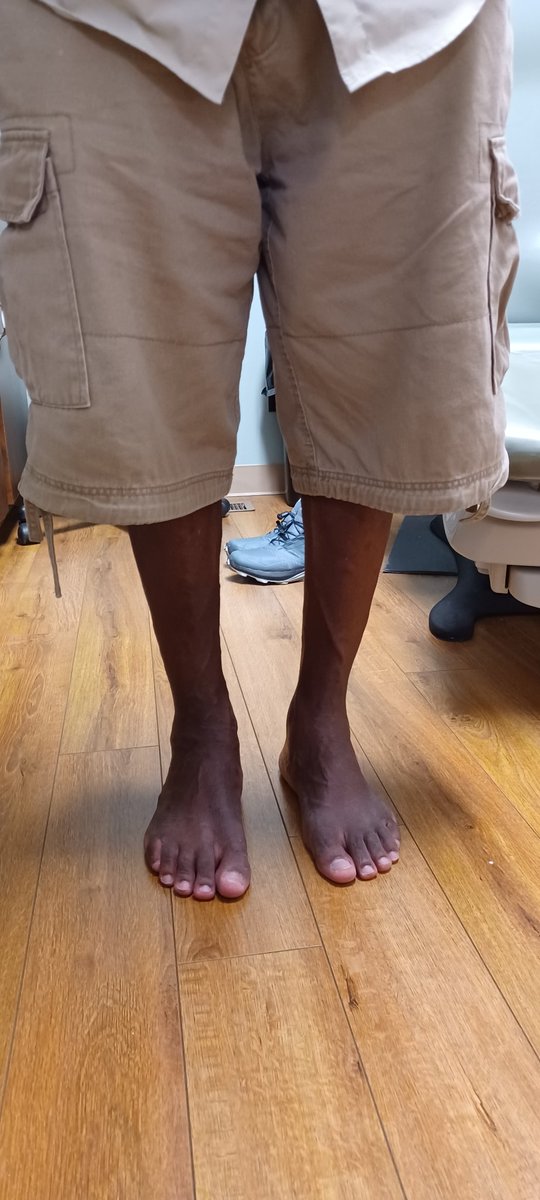 gramedica's tweet photo. "This is Mr. Charles Cooper, a great success story for the Center for Ankle, Foot & Wound Care. Mr. Cooper is on his way to a quick recovery after bilateral HyProCure surgery. He has been given a sense of well-being and wholeness after a long..." Dr. Joseph Picciotti #hyprocure https://t.co/u417MptfI4