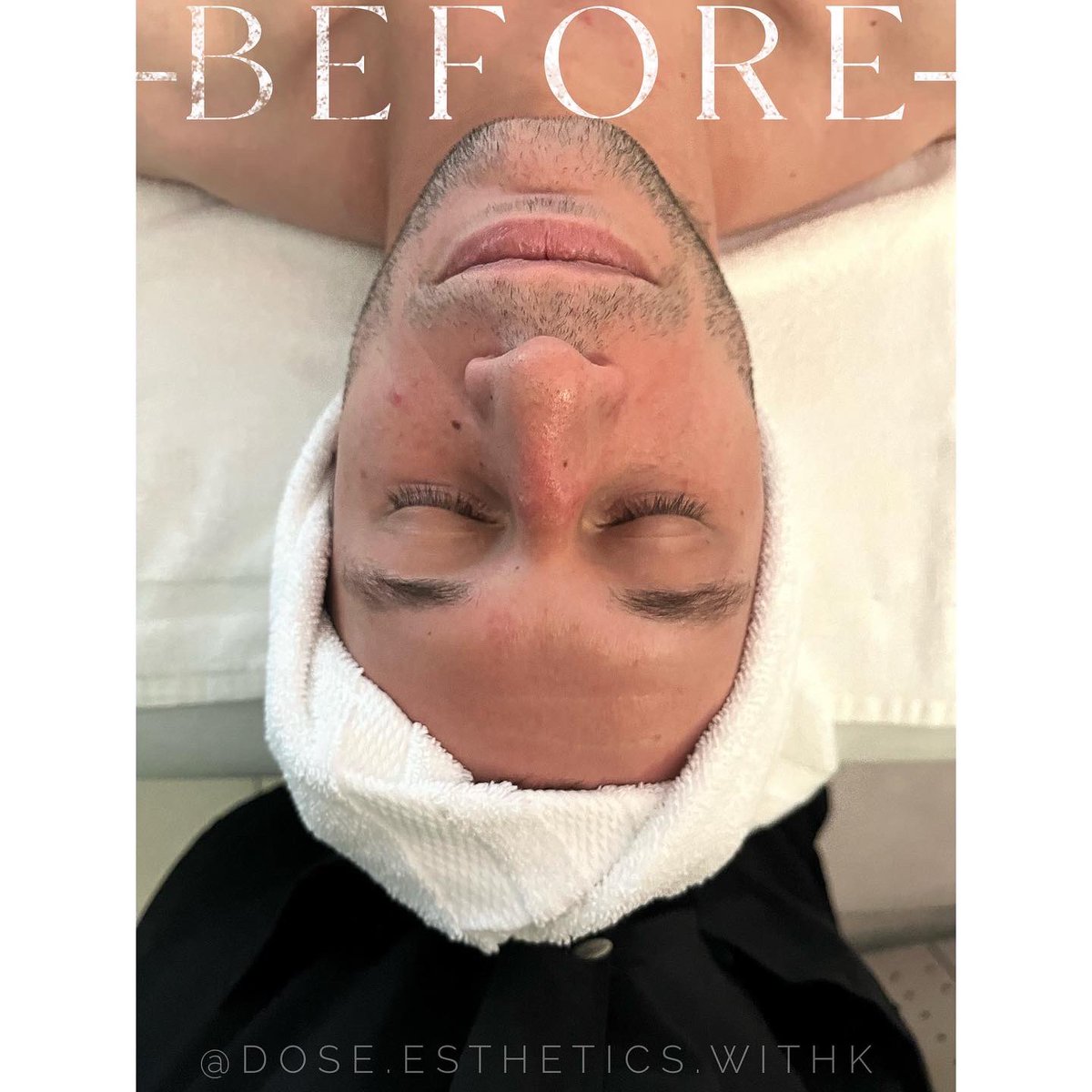 k_ki11a's tweet photo. First male client // microdermabrasion treatment with a hydrojelly mask and serum to treat dry and dehydrated skin 🪩 https://t.co/vc9pxiNbDV