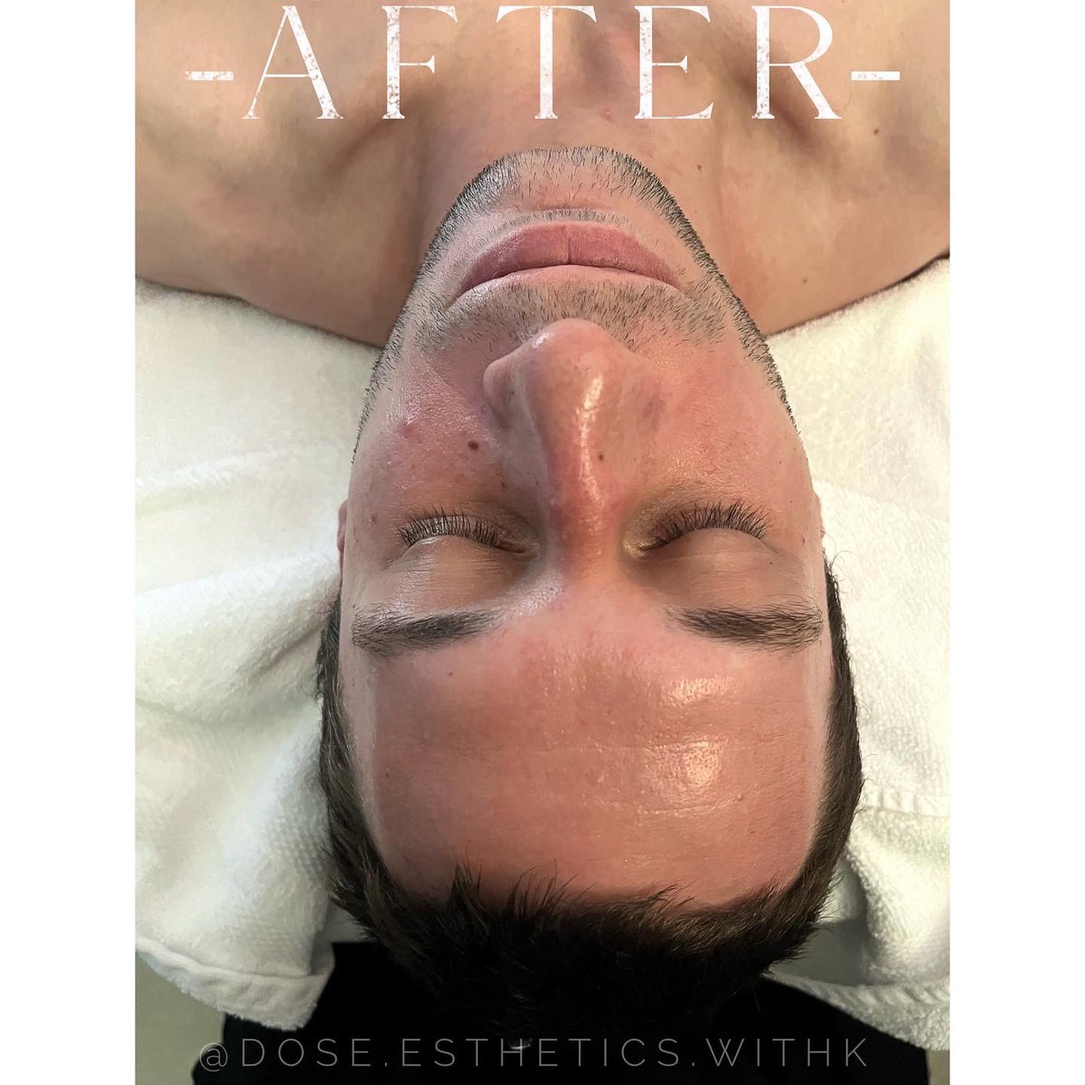 k_ki11a's tweet photo. First male client // microdermabrasion treatment with a hydrojelly mask and serum to treat dry and dehydrated skin 🪩 https://t.co/vc9pxiNbDV