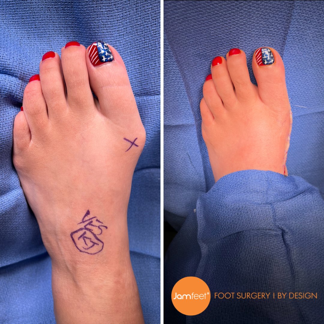 towerfootnankle's tweet photo. We are so happy for our lovely patient’s Dramatic before and after transformation after a short surgical treatment! https://t.co/a9Q9sicORO