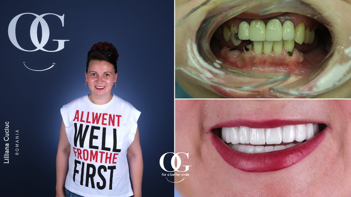 dtozanguner's tweet photo. Wow what an amazing transformation! Lilliana Cuciuc visited us from the Romania. We made full mouth OG Smile for Lilliana! Smile forever ๐๐คฉ
๐+491783233900
#ogsmile #dentalimplants #dentalclinic #smile #smilemakeover #beforeandafter #veneers #dentalphotography https://t.co/KNIRJnlZNd