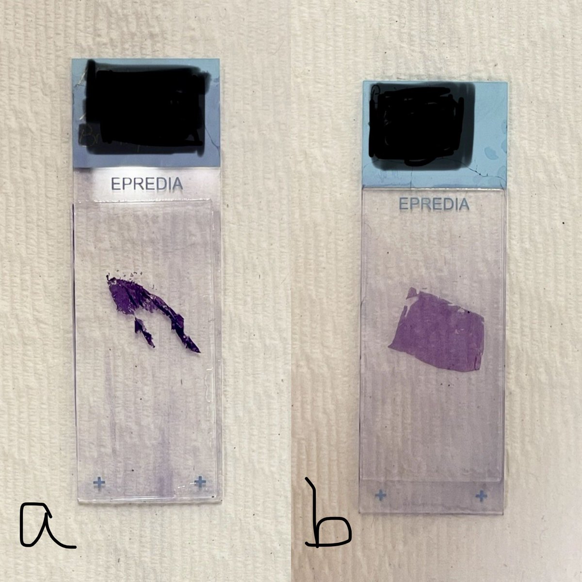 MonkeyWaffle's tweet photo. Pathology hack for #PathTwitter: you can, in fact, take frozen sections on formalin-fixed tissue. Freeze your tissue like normal but use a charged slide and microwave slide for ~15 secs before staining. Pic a: no microwave, pic b: after microwave @leon_metlay https://t.co/TMTq66aECH