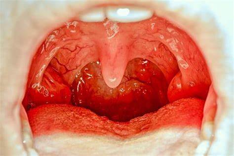 vida_incluyente's tweet photo. Uvulitis
Tipo: Infección bacteriana
La #Uvulitis es una inflamación de la úvula (campanilla). La úvula es el pequeño pedazo de tejido que cuelga en la parte posterior de la garganta cuando abre la boca. https://t.co/NzsGqhpLZq