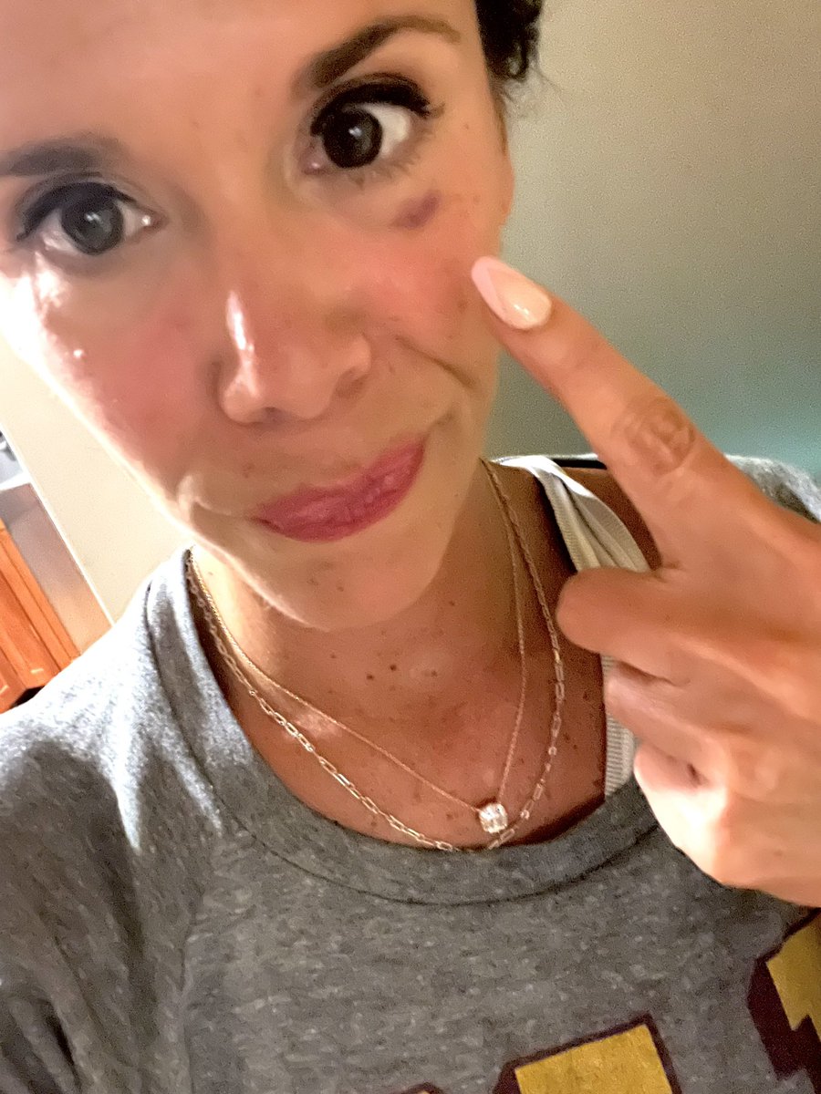 lanamarie27's tweet image. I don’t like to brag about my athletic prowess but … I got a black eye whilst playing Pop A Shot. #DerpyAF