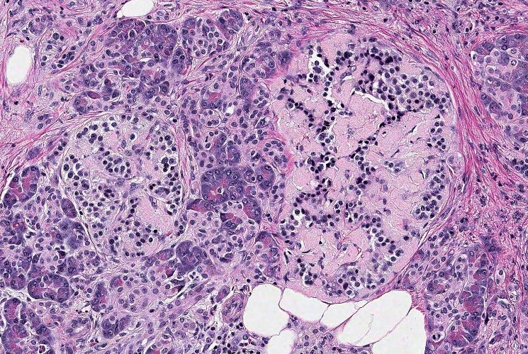 hulya_sahinn's tweet photo. Hi #PathTwitter! What do you think?🤗🔬 Hint: If one looks at patient's medical history, they would see a chronic disease.🍭 #pathology #pathresidents #medstudenttwitter #GIpath #PBpath https://t.co/uKYMlvYjCz