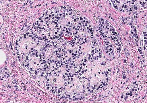 hulya_sahinn's tweet photo. Hi #PathTwitter! What do you think?🤗🔬 Hint: If one looks at patient's medical history, they would see a chronic disease.🍭 #pathology #pathresidents #medstudenttwitter #GIpath #PBpath https://t.co/uKYMlvYjCz