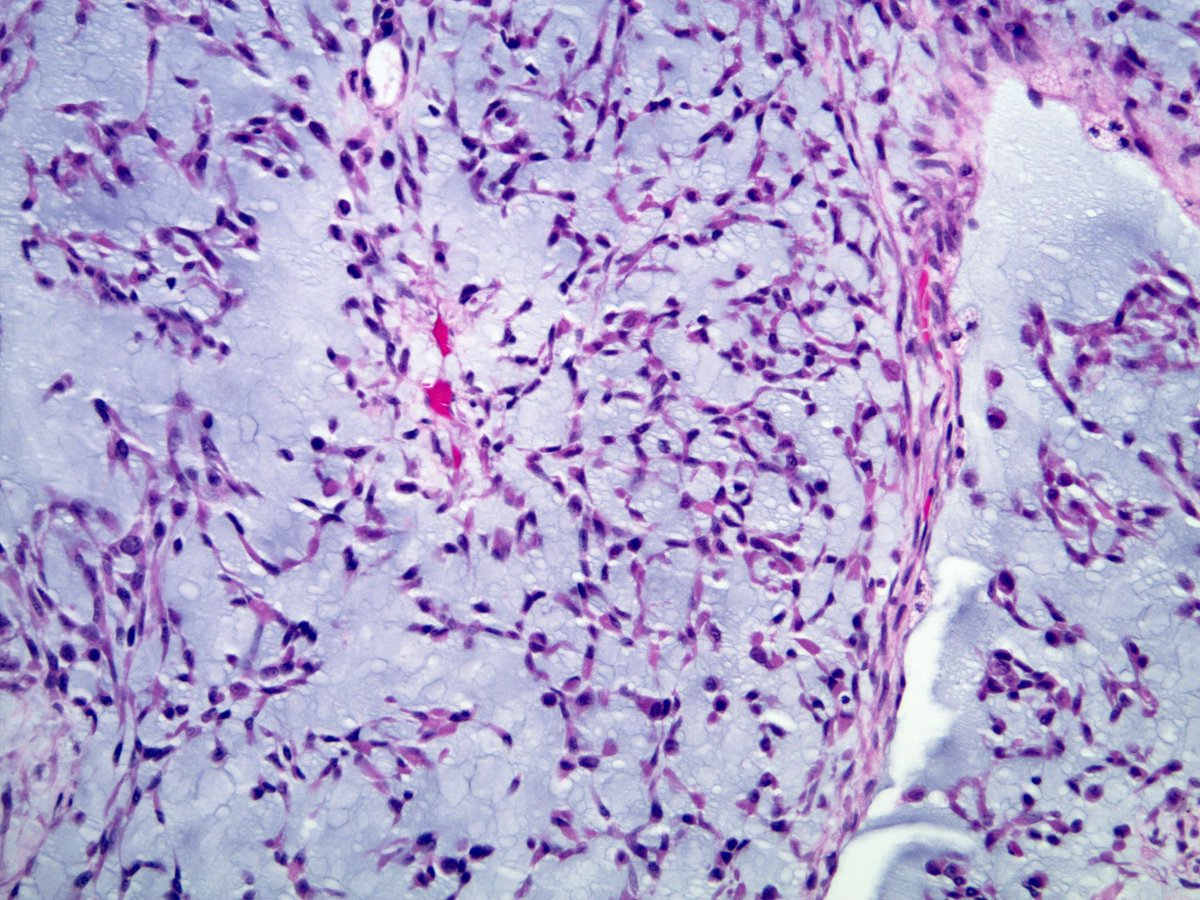 smlungpathguy's tweet photo. 1. I have a low mag pattern that is instantly recognizable (“spotter”)
2. I metastasize to the lungs, often after many years 
3. I have a distinctive translocation 
4. My name is a bit of a misnomer 
5. Immunos don��t really help to diagnose me 

Who am I? #pathology #pulmpath https://t.co/CdffrJIcZz