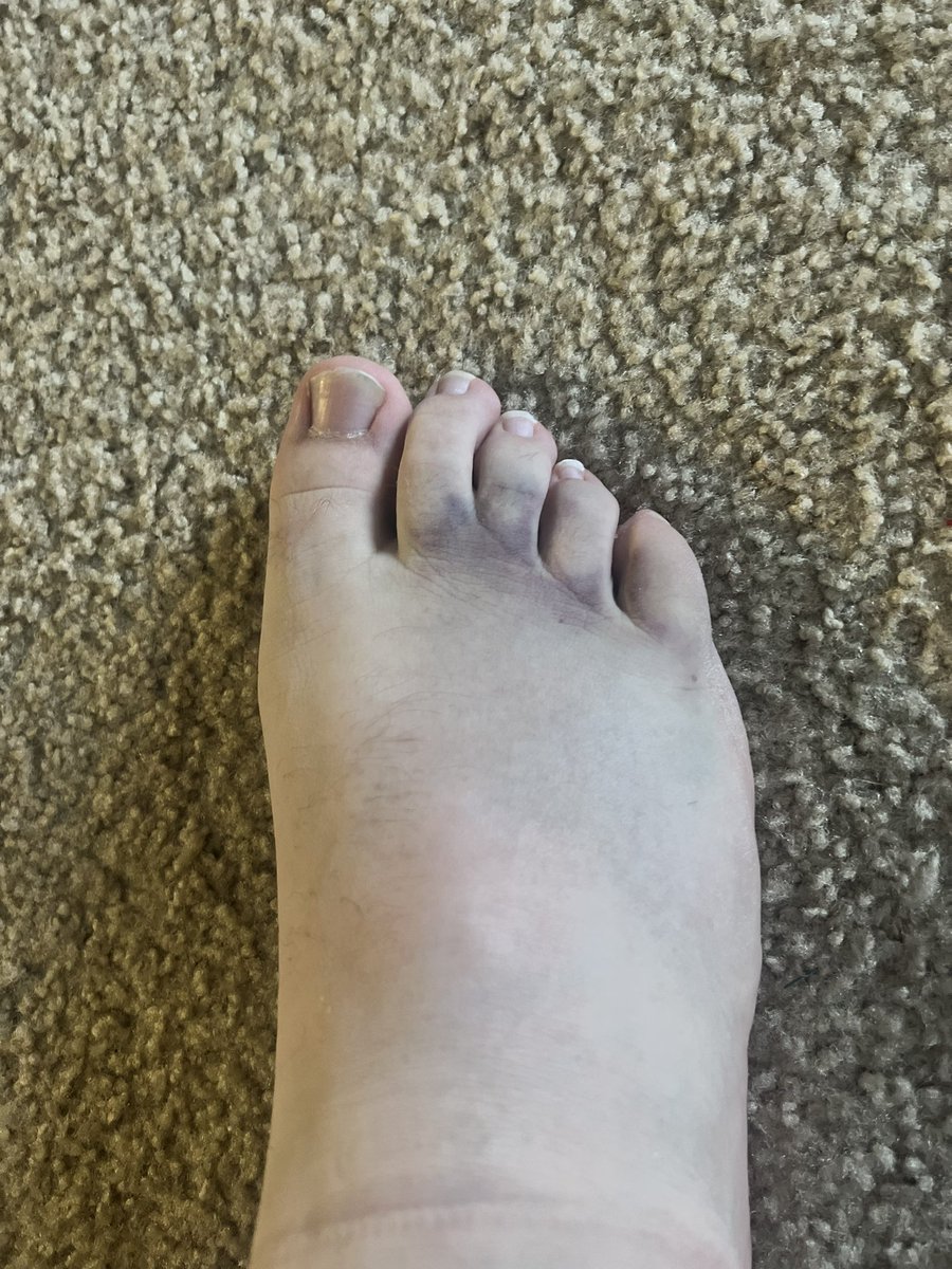 MediumMyke's tweet image. When you change jobs and don’t have health insurance for 60 days, what do you do?

Break your foot of course! 

#HealthcareIsAHumanRight #WhyIsHealthcareTiedToEmployment #AmericanHealthcare #Murica #FreeDumb