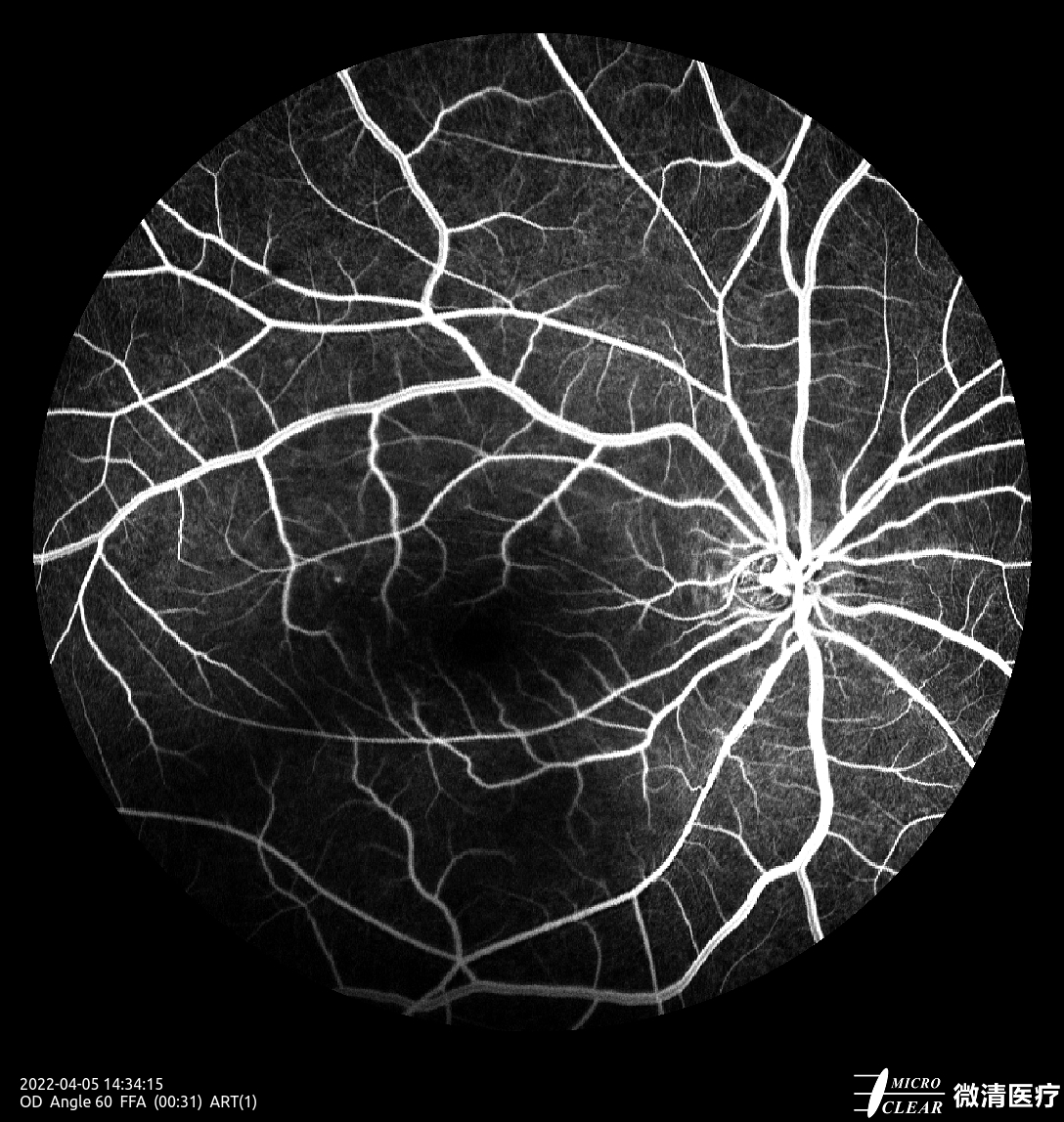 Microcleartec's tweet photo. #CentralSerousChorioretinopathy, CSC
Pictured by Apollo the #confocalretinalophthalmoscope
#retinopathy #angiography #FFA #funduscamera #ophthalmology #ophthalmic https://t.co/Tj7SdHzGui