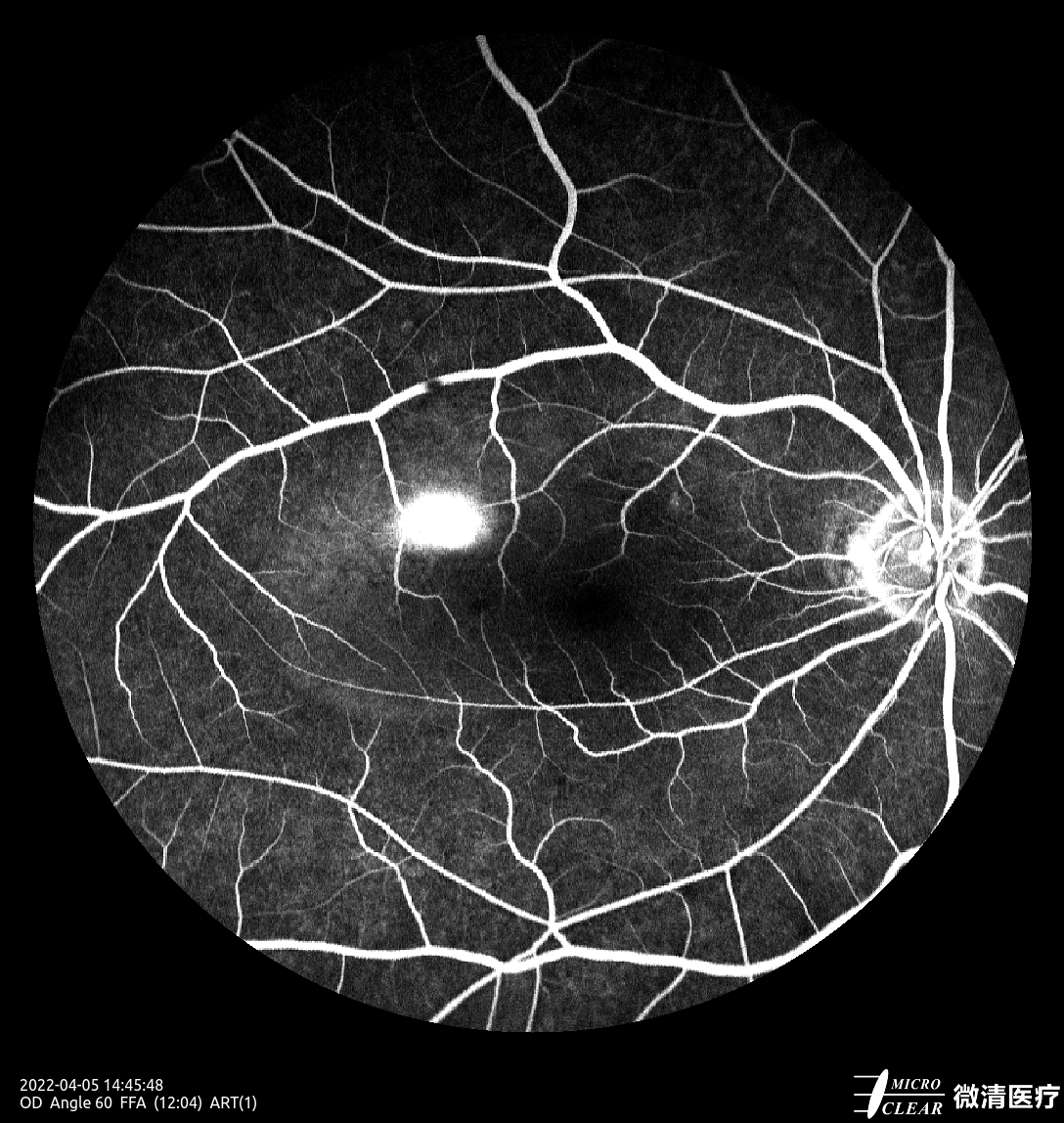 #CentralSerousChorioretinopathy, CSC
Pictured by Apollo the #confocalretinalophthalmoscope
#retinopathy #angiography #FFA #funduscamera #ophthalmology #ophthalmic