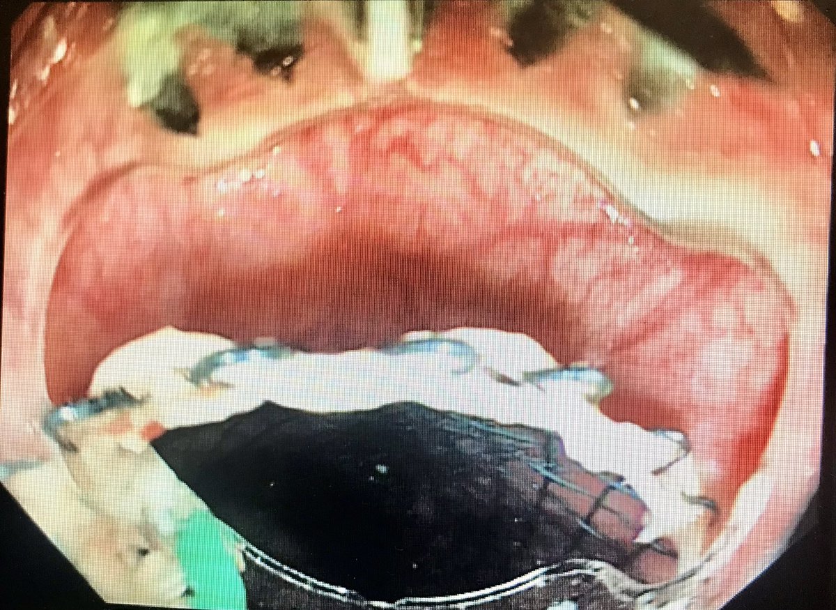 anjan_dhar6's tweet photo. Steps in using a Ovesco Stent fix to anchor oesophageal stents to prevent migration. Cost effective, cheaper than suturing, and easy. @CDDFTRnI @BSGTrainees https://t.co/tphycEAczc