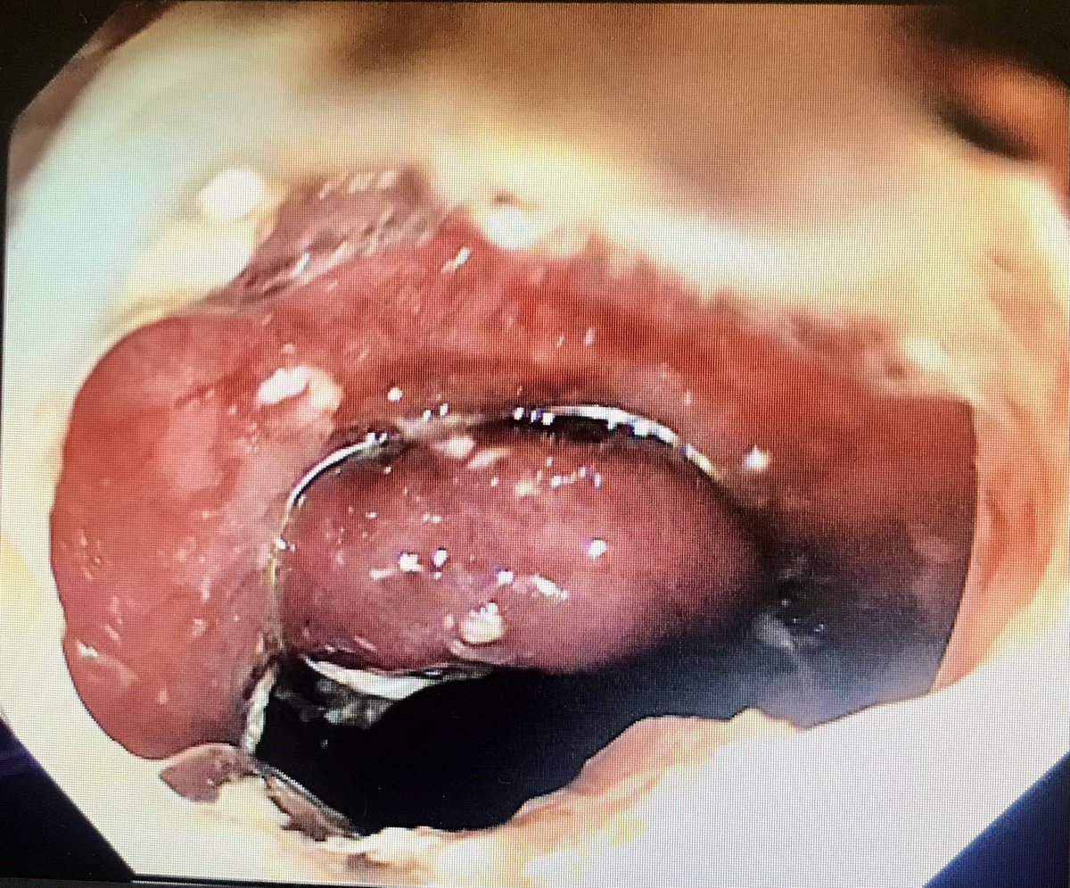 anjan_dhar6's tweet photo. Steps in using a Ovesco Stent fix to anchor oesophageal stents to prevent migration. Cost effective, cheaper than suturing, and easy. @CDDFTRnI @BSGTrainees https://t.co/tphycEAczc