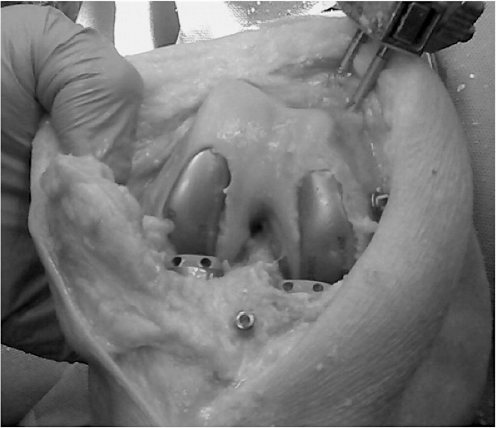 BoneJointJ's tweet photo. Robotic-assisted, cruciate-sparing bi-UKA maintains the natural anatomy of the knee in the coronal, sagittal, &amp; axial planes better, &amp; may therefore preserve normal joint kinematics, compared with a mechanically aligned TKA. 

#arthroplasty #knee

https://t.co/2t2DaKjNii https://t.co/kdEEpcbZKS