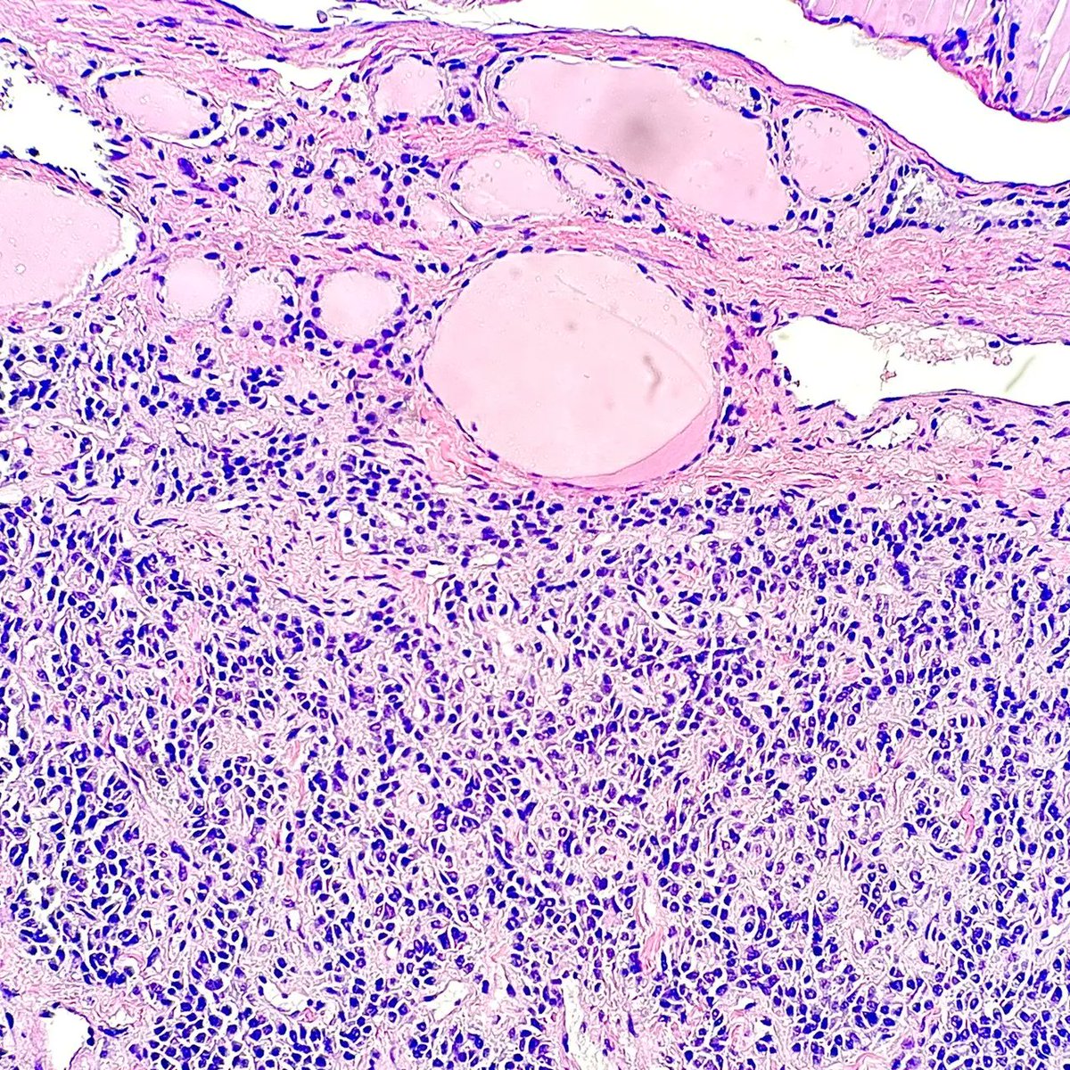 Gloria_SuraMD's tweet photo. Thyroidectomy revealing what type of cancer? Answer: https://t.co/VTA7CKlXsc  #PathTwitter #MedTwitter #PathArt https://t.co/hPHNTn5rSG