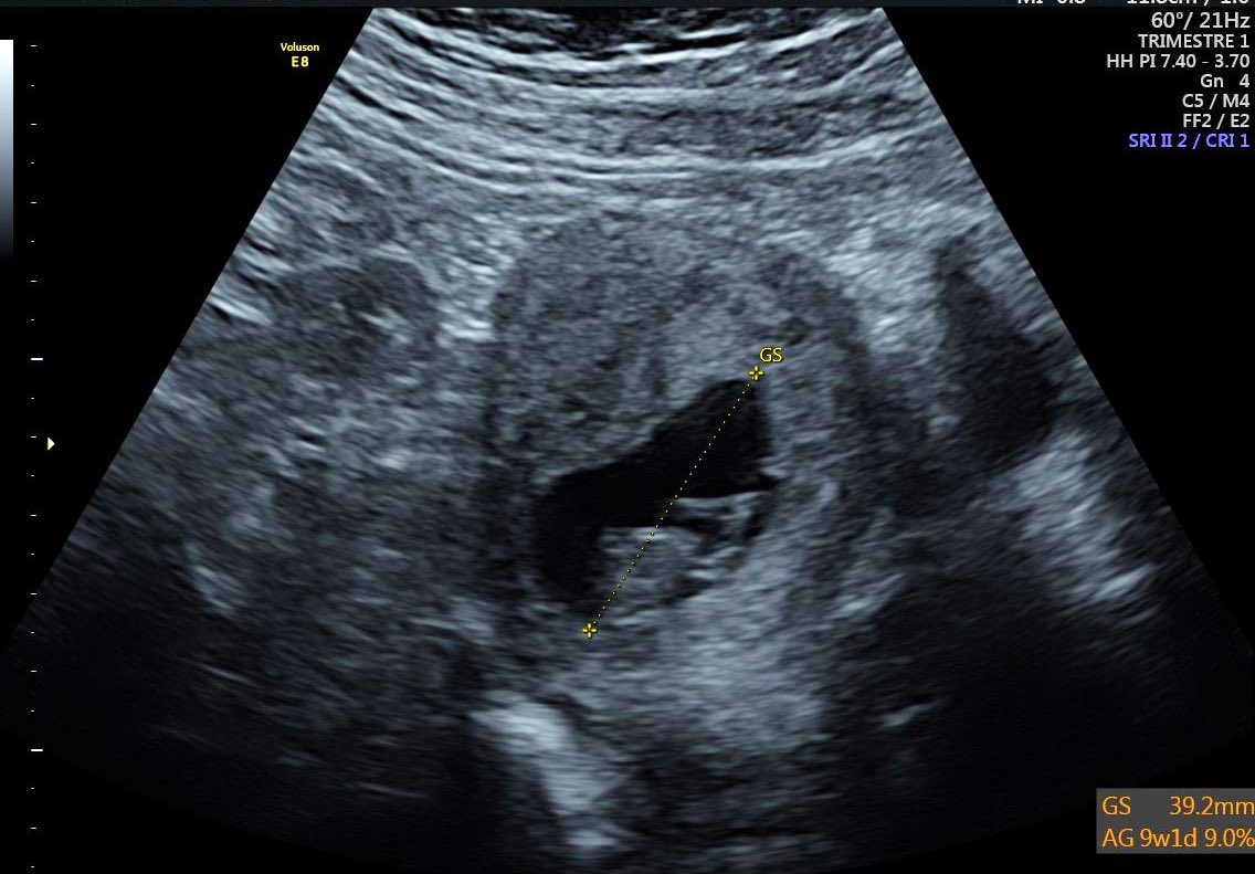 richet_oceane's tweet photo. Un ou une futur(e) pailladin(e) est en route, hâte de revoir mon baby, nous t’aimons déjà plus que tout baby #futuremaman #futurpapa 🤰❤️ https://t.co/lf5vD1FEJP