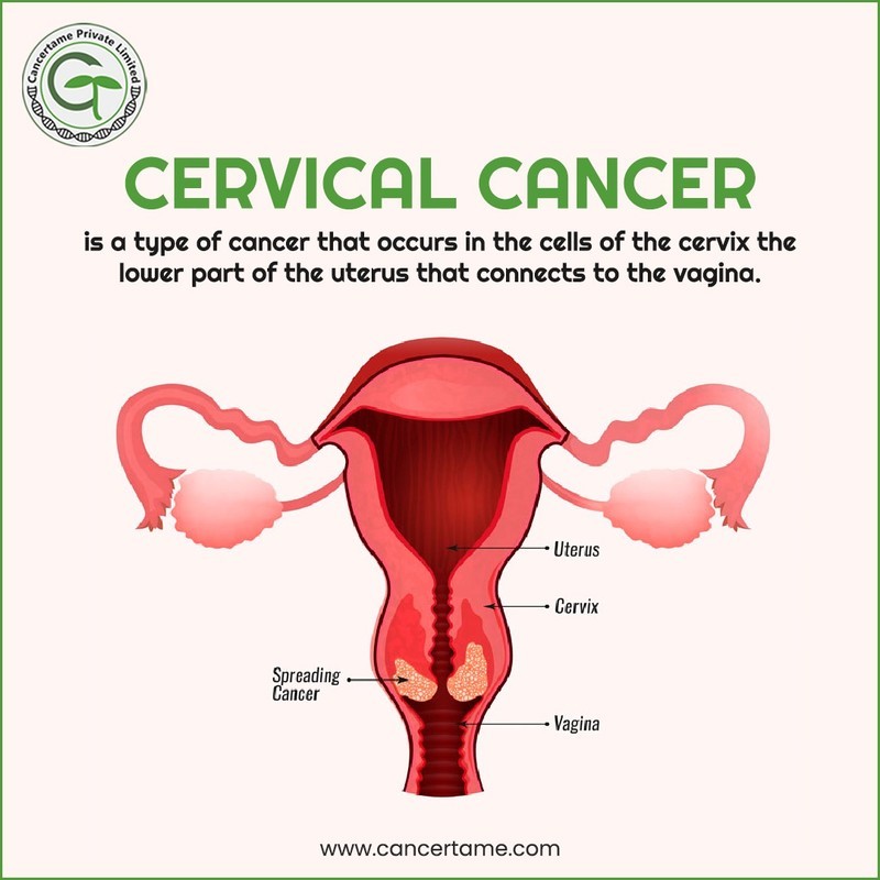 Cervical cancer starts in the cervix, which is the lower, narrow part of the uterus.
#cancercare #ourspecialities #besthospitalindelhi #besthospital