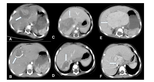 CVIR_Journal's tweet photo. 📚#IReadForYou @BarnacleAlex 
#paediatricIO lags far behind the progress made in adult #IO. The evidence is shockingly hard to establish due to inflexible oncology protocols. This is valuable data supporting IO in #hepatoblastoma
https://t.co/CsbBkCL33l https://t.co/mVFN2maRTI