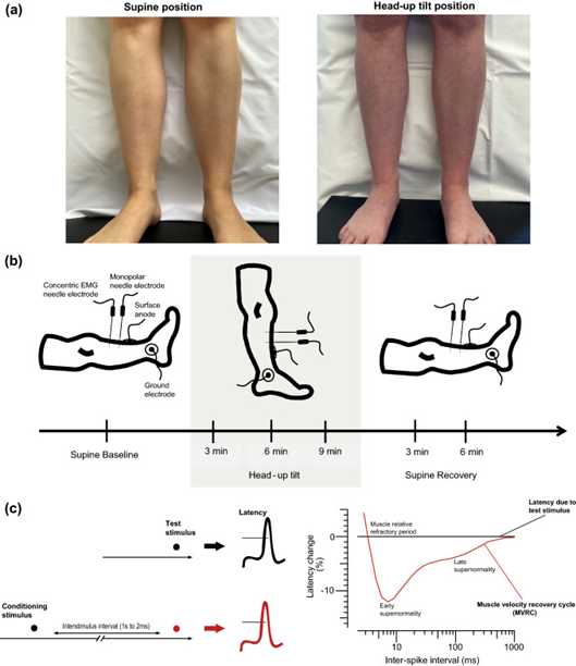 finapres's tweet photo. This study https://t.co/EMReos5929 examined muscle excitability depending on body position in patients with neuropathic postural tachycardia syndrome and healthy subjects. The #bloodpressure and #heartrate of the participants was measured with #Finapres devices!#POTS #orthostasis https://t.co/oRXVMpmHfu