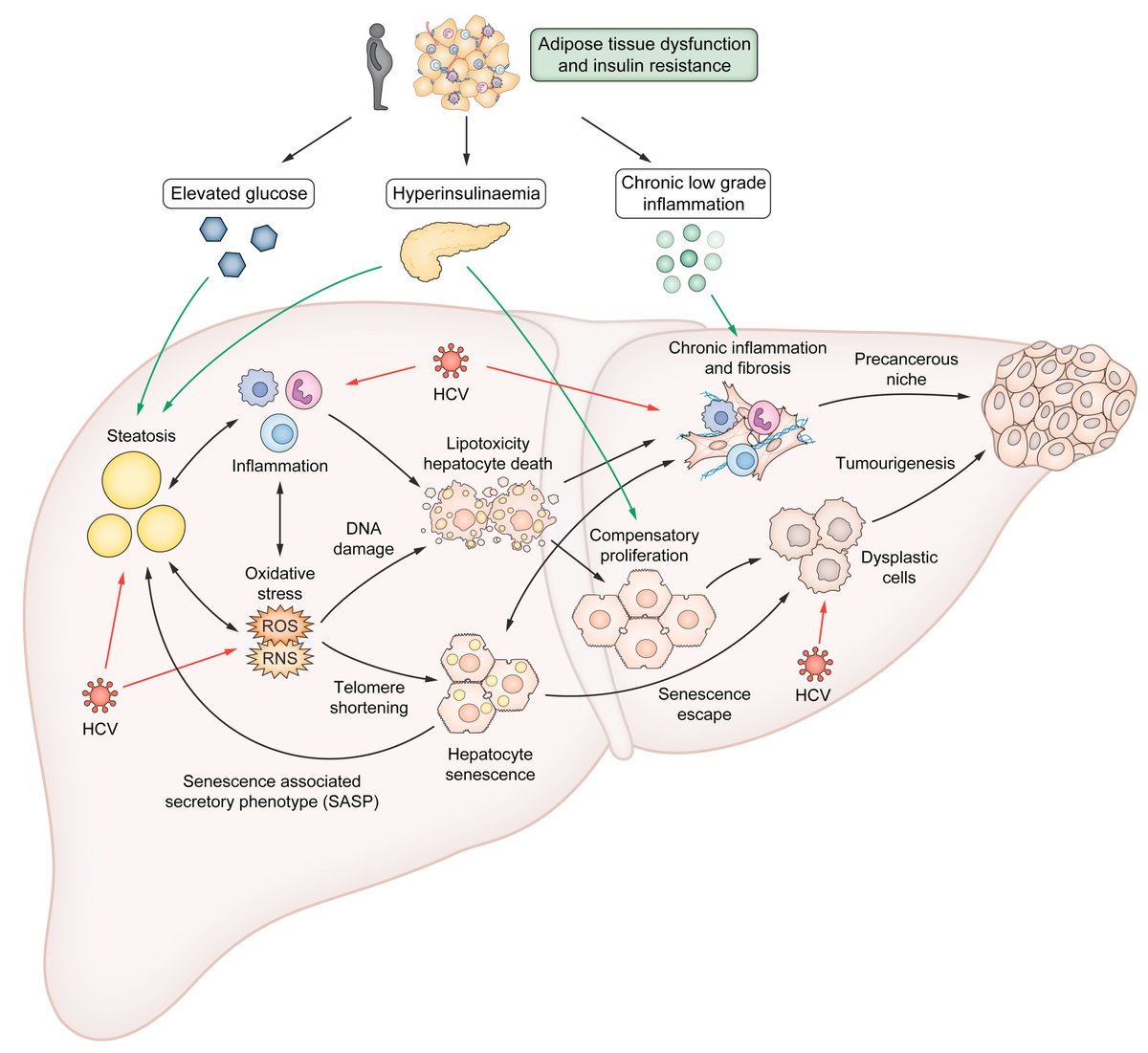 Metabolic disturbances caused by #HCV 
➡️can persist after successful treatment 
➡️can be a risk for development of #LiverCancer

🔓#OpenAccess at👉bit.ly/3JHBjmr

<a href="/FibrosisLab/">Fibrosis Lab</a>
<a href="/J__Leslie/">Jack Leslie</a>
<a href="/derekamann1/">Derek A Mann</a>
<a href="/MikeVacca1979/">Michele</a>
#LiverTwitter