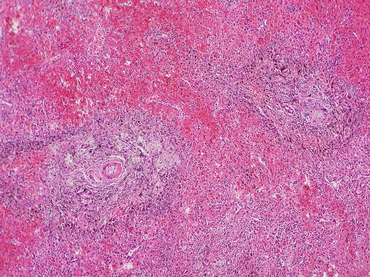 D4L14H's tweet photo. β οΈ #pathboard spot case
"Splenic Gandy Gamna bodies". Benign finding ass. w/ pathologic conditions such as portal hypertension, SCA, splenic vien thrombosis etc.
βοΈNever mistake it for neoplastic or infectious process. https://t.co/W7426KkTsm