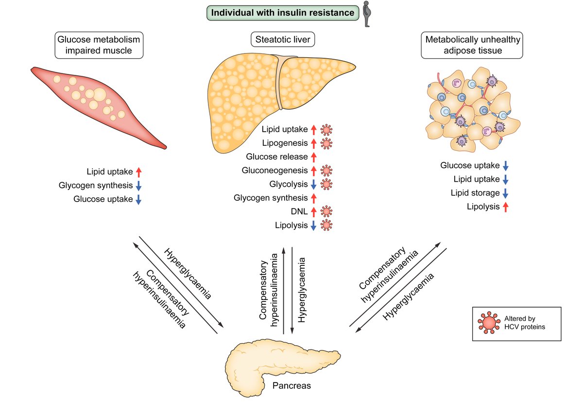 Metabolic disturbances caused by #HCV 
➡️can persist after successful treatment 
➡️can be a risk for development of #LiverCancer

🔓#OpenAccess at👉bit.ly/3JHBjmr

<a href="/FibrosisLab/">Fibrosis Lab</a>
<a href="/J__Leslie/">Jack Leslie</a>
<a href="/derekamann1/">Derek A Mann</a>
<a href="/MikeVacca1979/">Michele</a>
#LiverTwitter